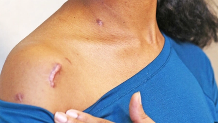 Cicatrice cheloidă. Cum să lupți împotriva defecțiunii estetice