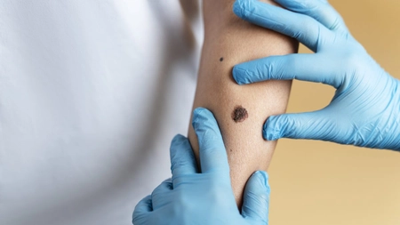 Ce se întâmplă dacă rupem alunițele? Medicul dermatolog Claudia Artenie: „Traumatizarea unui nev nu duce la malignizare” - VIDEO