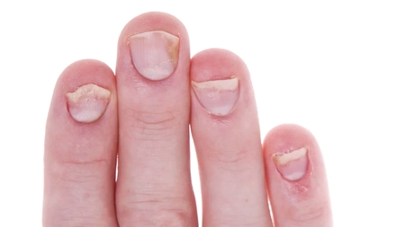 Psoriazis la unghii. Manifestările bolii și terapia recomandată de medici