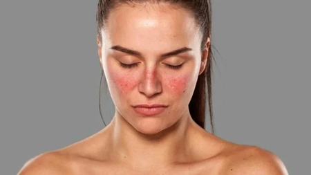 Boala lupus – poze. Cât de periculoasă este aceasta și factorii declanșatori