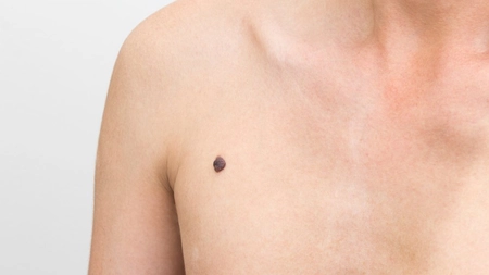 Melanom malign – poze. Diferența dintre o aluniță și o formare canceroasă