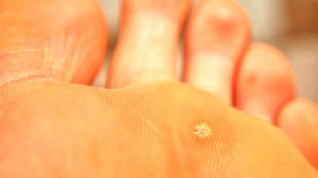 Veruca plantară. De ce virus este provocată boala?