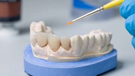 5 motive pentru care să optezi pentru o coroană dentară