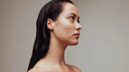 Acnee chistică. Când este cazul să consulți un dermatolog pentru a obține un tratament eficient?