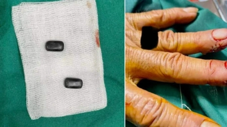 Motivul incredibil pentru care un bărbat din Thailanda și-a implatat magneți în degete
