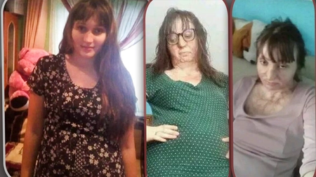 Într-o fracțiune de secundă, viața unei tinere din Iași s-a schimbat radical: „A ieșit în flăcări afară din casă și, pentru că nu vedea, a dat cu capul de toți pereții” - FOTO