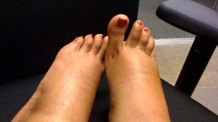 Degetul mic de la picior este umflat. Ce să faci pentru a ameliora disconfortul?