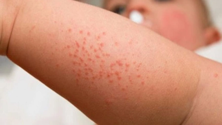 Simptome care indică meningita și septicemia la copii. Testul paharului pentru erupții ale pielii – Poze