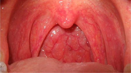 Faringita acută, una dintre cele mai comune afectiuni ale cailor respiratorii