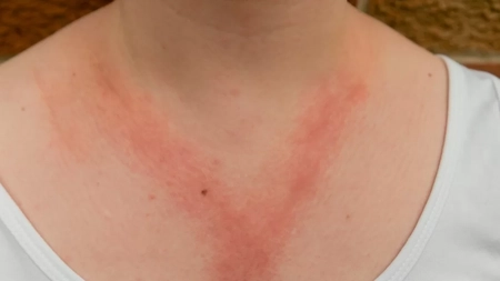Ce este dermatita alergică și de câte feluri poate fi