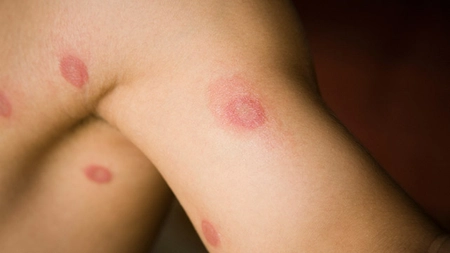 Infecție în sânge. Ce analize trebuie efectuate în acest caz