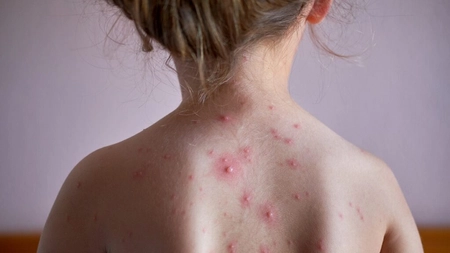 Cât de gravă este varicela infectată? Soluții naturiste pentru a calma problema la domiciliu