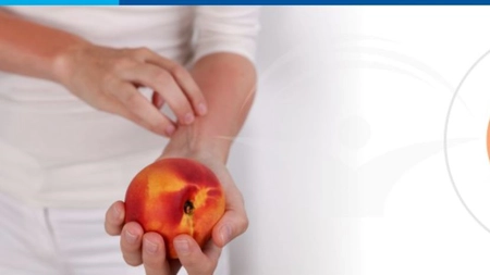Cum știi că suferi de o alergie alimentară. Primele simptome și la ce trebuie să fim atenți