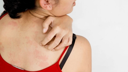 Tot ce trebuie să știi despre eczema pe piele – Cauze, manifestări, tratament
