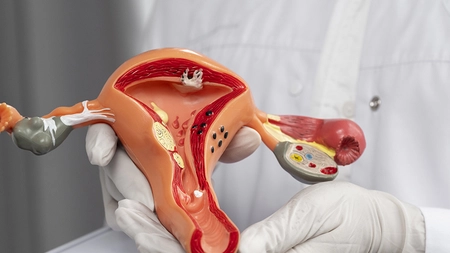 Tratarea fibromului uterin fără operație! Ce metode sunt eficiente și sigure?