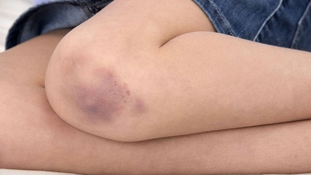 De ce apar vânătăi pe picioare fără să te lovești? Cauze și metode de prevenție