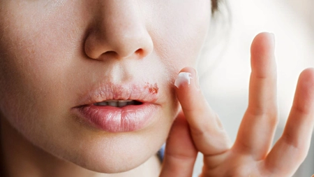 Care este tratamentul rapid pentru un herpes la buză? Poți scăpa de el în câteva ore!