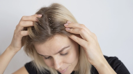 Care este tratamentul optim pentru dermatita scalpului? Poate afecta persoanele de orice vârstă!