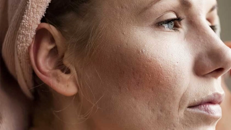 Dermatita la adulți, poze. Ce remedii naturiste poți folosi pentru tratarea pielii