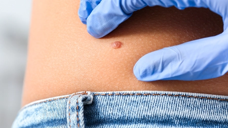 Durata de viață a pacienților cu carcinom bazocelular! Iată ce trebuie să știi despre simptome și diagnostic!