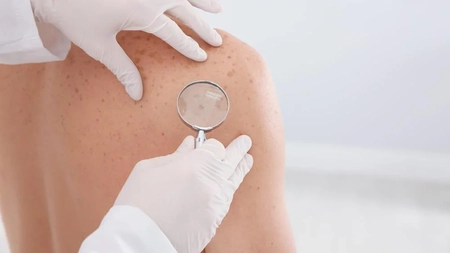 Pityriasis rosea, poze. Care sunt cauzele afecțiunii și cum se manifestă