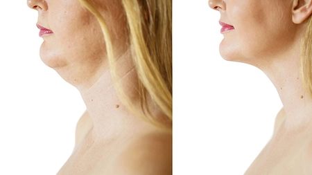 Iată cum scapi de bărbia dublă sau de gușă, antrenând mușchii feței! Modelarea feței fără chirurgie