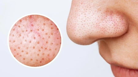 Tratamente pentru puncte negre pe care le poți face acasă! Iată cum le elimini natural!
