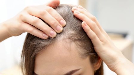Alopecia areata. Ce poți face pentru a lupta împotriva căderii părului