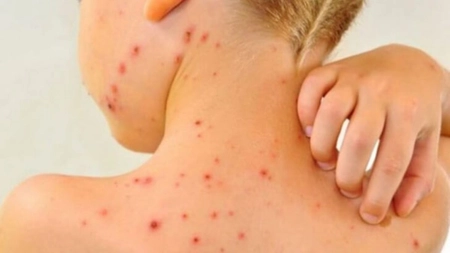 Cât durează pojarul? Simptome și prevenire
