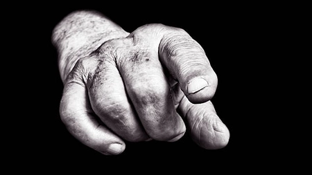 Cazul bărbatului cu piele cenușie! Medicii au descoperit o afecțiune rară după cinci ani de mister