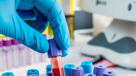 Ce valori ale analizelor indică leucemie? Iată care sunt testele de confirmare ale diagnosticului!