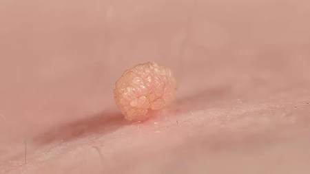 Ce poți face atunci când ai carne crescută în zona genitală – poze. Ce virus cauzează afecțiunea și cum poți elimina disconfortul