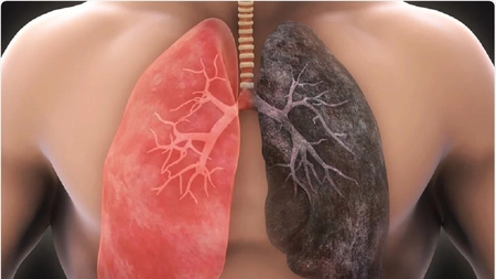 Cancer la plămâni – Simptome, cauze și diagnostic