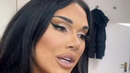 Aproape și-a deformat fața după operația estetică! „Nu este normal!”