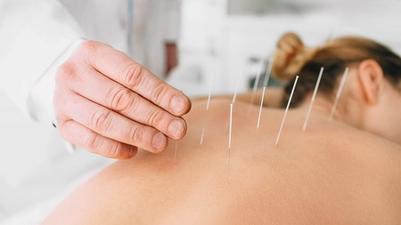 De ce este periculoasă acupunctura? Află cât de sigură este, de fapt, medicina alternativă!