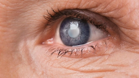 Cât costă operația de cataractă pentru pensionari? Află toate detaliile