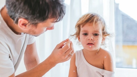 Ce remedii calmează mâncărimea la varicelă? Află de ce adulții fac forme mai severe!