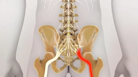 Unde se află nervul sciatic? Află tot ce trebuie să știi despre acesta