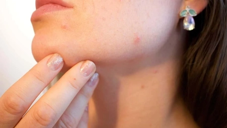 Poți face varicelă de 2 ori? Tot ce trebuie să știi despre riscul de reinfecție
