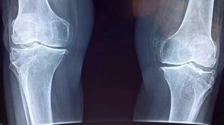 Radiografia de genunchi – În ce situații se face și cum se efectuează procedura?