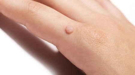 Cum se tratează veruca vulgară? Manifestări clinice produse de infecția cu virusuri HPV!