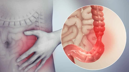 Ce este sindromul intestinului iritabil? Iată ce complicații pot apărea!