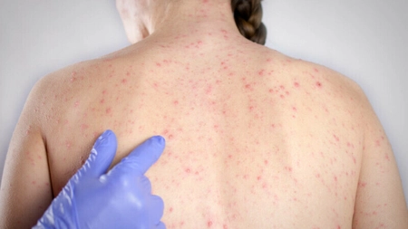 Explozie de cazuri de rujeolă în România! <em class='ep-highlight'>Peste</em> 1.000 de îmbolnăviri într-o singură lună și bilanț tragic de decese
