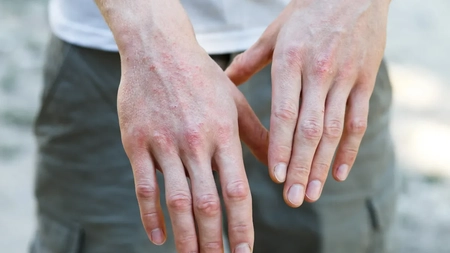 Cum arată psoriazis la început. Iată la ce simptome trebuie să fii atent!