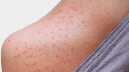 Miliaria, erupția provocată de căldură. Cum recunoști iritația și ce măsuri să iei pentru a o preveni