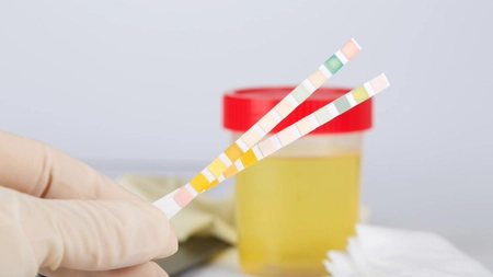Prezența nitriților pozitivi în urină, semn de infecție? Iată care sunt cauzele!