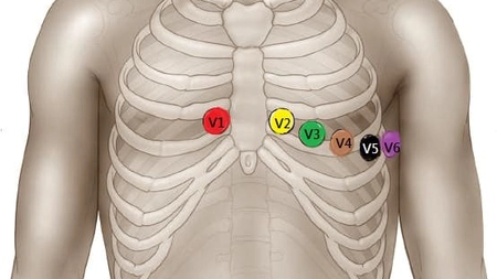Ghid complet de poziționare electrozi EKG pentru o înregistrare corectă!