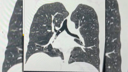Dorea să facă un tratament pentru durerea de gât, dar a ajuns de urgență la Spitalul Clinic de Pneumoftiziologie Iași, după ce a inspirat o piesă a inhalatorului