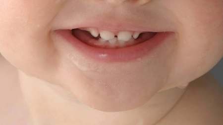 Cât durează durerea de dinți la bebeluși? Iată tot ce trebuie să știi despre această perioadă dificilă