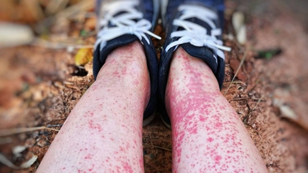 Care sunt cauzele trombocitelor scăzute? Iată cum poți să tratezi trombocitopenia!